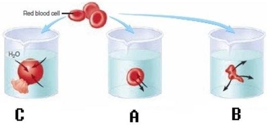   -Red blood cells (RBCs)  have been placed in three different solutions: hypotonic, hypertonic, isotonic. What is solution  B  relative to the RBC? A)  Hypotonic solution B)  Hypertonic solution C)  Isotonic solution