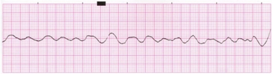 The nurse notes this rhythm on the patient's cardiac monitor.What is the nurse's priority intervention?   A) Check the patient's pulse. B) Administer oxygen. C) Call a code blue. D) Prepare to cardiovert the patient. 