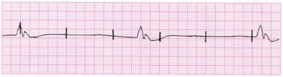 A patient with a temporary pacemaker has this cardiac rhythm.What nursing intervention is indicated?   A) Turn the impulse generator off,wait 30 seconds,and turn it back on. B) Call for a STAT portable chest x-ray. C) Check for a damaged lead wire. D) Decrease the pacemaker sensitivity. 