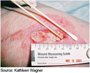 The nurse is assessing a wound using the technique shown in this picture.How would the nurse document this assessment?   A) The wound is macerated. B) The wound is tunneled. C) The wound is deep. D) The wound is filled with exudate. 