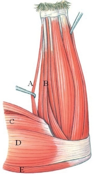 Identify the muscle labeled A in the following figure.   A)  palmaris longus B)  flexor carpi ulnaris C)  biceps brachii D)  epitrochlearis E)  triceps brachii