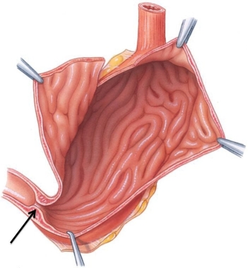 Identify the structure at the tip of the arrow in the following figure.   A)  pyloric sphincter B)  ileocecal sphincter C)  lower esophageal sphincter D)  anal sphincter