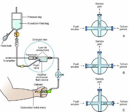 On the basis of the position of the three-way stopcock shown here, identify which of the following activities related to arterial lineblood sampling is occurring.   A)  The therapist is aspirating blood diluted with infusion fluid. B)  The therapist is withdrawing blood from the arterial line. C)  The therapist is keeping the stopcock in its normal operational position. D)  The therapist is infusing fluid back into the system after having removed a blood sample. 
