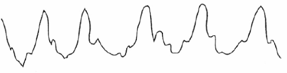 On the basis of the following waveform, in which of the following anatomic locations is the distal tip of the pulmonary artery catheter located?   A)  Right atrium B)  Right ventricle C)  Pulmonary artery D)  Wedged position 