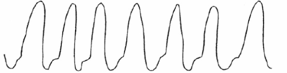 On the basis of the following waveform, in which of the following anatomic locations is the distal tip of the pulmonary artery catheter located?   A)  Right atrium B)  Right ventricle C)  Pulmonary artery D)  Wedged position 