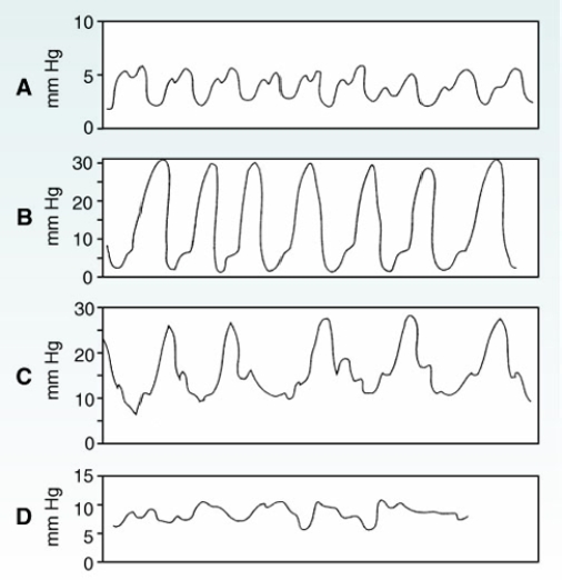 Which of the following pulmonary artery catheter waveforms represents the catheter's normal location?   A)  Right atrium B)  Right ventricle C)  Pulmonary artery D)  Wedged position 