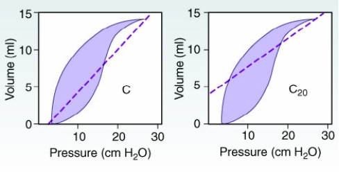How should the therapist interpret the following pressure-volume loop obtained from a mechanically ventilated infant?   A)  A leak has developed in the ventilator patient system. B)  The patient's lungs are being overinflated. C)  The patient is displaying trigger dyssynchrony. D)  The patient's lungs are exhibiting increased compliance. 