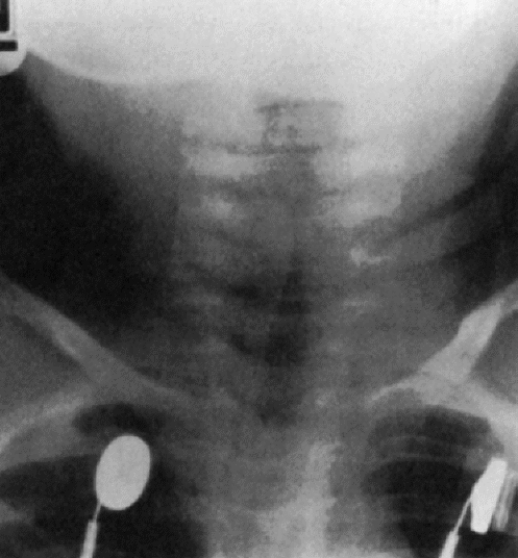 Which of the following lateral neck radiographic presentations is characteristic of laryngotracheobronchitis?   A)  Posterior pharyngeal shadow B)  Thumb sign C)  Steeple sign D)  Penumbra effect 