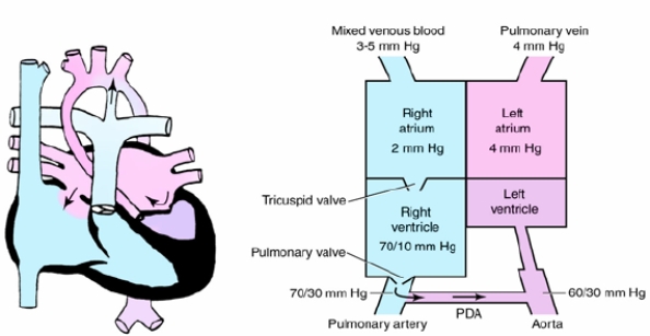 Identify the congenital cardiac defect depicted in the following illustration:   A)  Atrial septal defect B)  Hypoplastic left ventricular syndrome C)  Hypoplastic right ventricular syndrome D)  Atrioventricular canal defect 