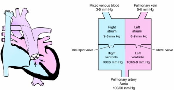 Identify the following congenital cardiac anomaly:   A)  Truncus arteriosus B)  Hypoplastic left ventricle C)  Transposition of the great vessels D)  Ventricular septal defect 