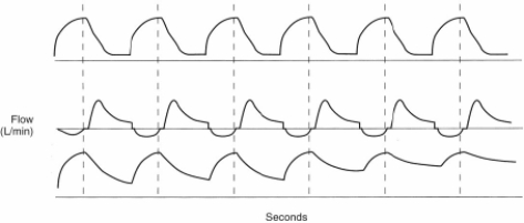 On the basis of the following flow/time scalar, which of the following conditions has developed?   A)  Trigger dyssynchrony B)  Excess tidal volume C)  Air trapping D)  Ventilator circuit leak 