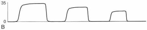 Over the last 90 minutes, the therapist has obtained three arterial blood samples from an arterial line inserted in a neonate receiving mechanical ventilation and being monitored by capnometry. The PaCO<sub>2</sub> values were as follows: (1)  47 mm Hg, (2)  46 mm Hg, and (3)  47 mm Hg. How should the therapist evaluate the following capnogram?   A)  Abrupt disconnection from mechanical ventilation B)  Damped waveform caused by severe airflow obstruction C)  Reduced pulmonary blood flow caused by overdistention of the lungs D)  Secretions partially obstructing the sample line leading to the capnometer 