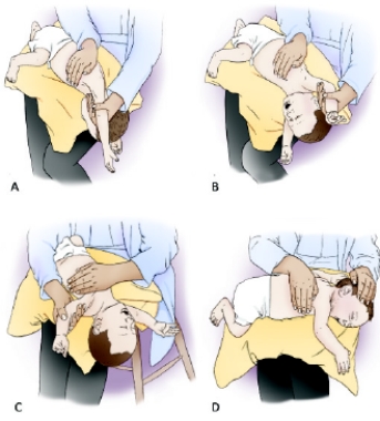 The following postural drainage positions are shown for an infant patient.   Which of the diagrams demonstrates the postural drainage position for draining the lingular segments of the left upper lobe in an infant? A)  Image A B)  Image B C)  Image C D)  Image D 