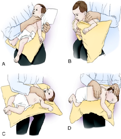 The following postural drainage positions are shown for a pediatric patient.   Which of the diagrams demonstrates the postural drainage position for draining the posterior subsegment of the apical-posterior segment of the left upper lobe? A)  Image B B)  Image C C)  Image A D)  Image D 