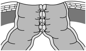 Identify the faecal diversion pictured below:  