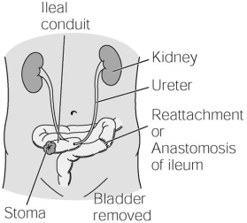 Identify this urinary diversion.  
