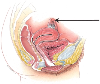 In this image of the female reproductive system, the line points to the   A)  ovary B)  fallopian tube C)  uterus D)  pubic symphysis E)  clitoris