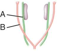 The image below shows undifferentiated internal reproductive structures. In a male, what will structure A differentiate into?   A)  vas deferens B)  gonads C)  fallopian tubes D)  Sertoli cells E)  rete testes
