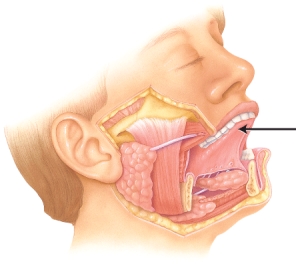 Identify the structure indicated in the image below.   A)  uvula B)  tongue C)  teeth D)  lips E)  cheek