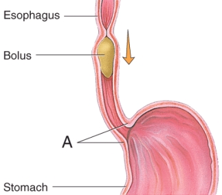 <strong>What is most likely to happen if the parts labeled A in the image fail to relax? </strong> A) narcosis B) edema C) pleurisy D) atelectasis E) achalasia