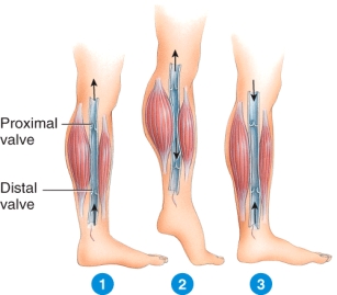 The second step in the image below is unlikely to be seen when an individual   A)  has legs of unequal length B)  is in a supine position C)  has a leg injury D)  is cycling E)  is running