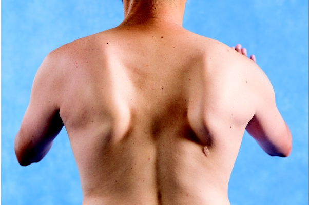   -As shown in the image, what scapular muscle(s)  is(are)  most likely weak? A) Rhomboids B) Serratus anterior C) Latissimus dorsi D) Lower trapezius