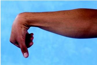   -The hand has a decreased ability to produce a powerful grip in the position as shown in the image.Why is this ability decreased? A) Passive insufficiency of finger flexors B) Passive insufficiency of finger extensors C) Active insufficiency of finger flexors D) Active insufficiency of finger extensors