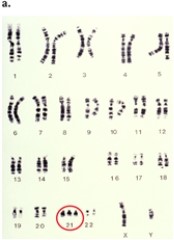 Figure 10-5   -Which genetic condition is revealed in the karyotype display in Figure 10-5? A)  cri-du-chat B)  triple-X syndrome C)  Turner syndrome D)  Down syndrome 
