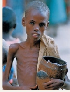 The child in the photo below is suffering from ___.   A) lack of iodine in the diet B) anorexia nervosa C) Kwashiorkor D) Marasmus E) overnutrition