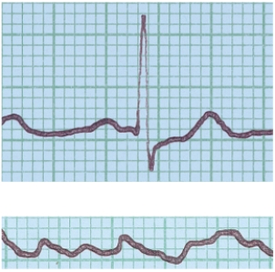 In the figure shown here, the top ECG shown is normal. What condition does the bottom ECG indicate?   A)  ventricular fibrillation B)  a heart murmur C)  hypertension D)  stroke E)  angina pectoris