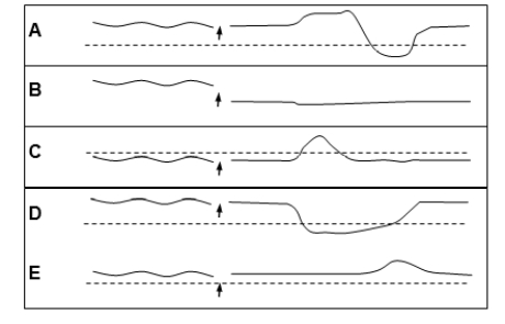 Which one of the following manometric recordings illustrates normal function of the esophagus at a point below the diaphragm before and after swallowing (arrow)? The dashed lines represent a pressure of 0 mm Hg.  