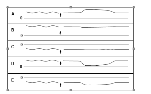 Which one of the pressure tracings given below illustrates normal function of the lower esophageal sphincter before and after swallowing (arrow)? The dashed line represents a pressure of 0 mm Hg.  