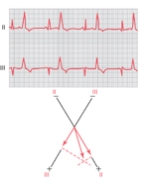 A forty-year-old man reported to his cardiologist that he had unusual feelings in his chest after drinking his fourth cup of coffee in the morning. The cardiologist recorded the following electrocardiogram during an exercise stress test. Leads II and III are shown. What is the likely diagnosis?   A) Premature contraction originating in the atrium B) Premature contraction originating high in the atrioventricular node C) Premature contraction originating low in the atrioventricular node D) Premature contraction originating in the apex of the ventricle E) Premature contraction originating in the base of the ventricle