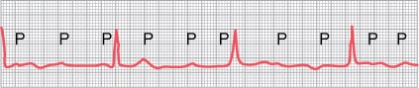   -Circus movements in the ventricle can lead to ventricular fibrillation. Which of the following conditions in the ventricular muscle will increase the tendency for circus movements? A) Decreased conduction velocity B) Low extracellular potassium concentration C) Increased refractory period D) Shorter conduction pathway (decreased ventricular volume)  E) Increase in parasympathetic impulses to the heart