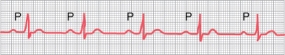 A 65-year-old man reported some unusual sensations in his chest. His blood pressure is 135/85 mm Hg, and he weighs 200 pounds. He had an electrocardiogram, which is shown below. What is his likely diagnosis?     A) Atrial paroxysmal tachycardia B) First-degree atrioventricular block C) Second-degree atrioventricular block D) Premature atrial contractions E) Premature ventricular contractions