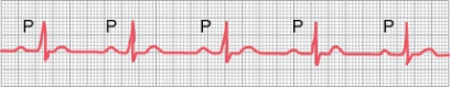 Use the following information to answer Following Questions : A 60-year-old woman was admitted to the emergency department after an automobile accident, where the following electrocardiogram was taken. Chest lead V<sub>2</sub> is shown.   -What is her heart rate in beats per minute? A) 40 B) 60 C) 75 D) 100 E) 150