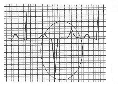 A 48-year-old man had unusual sensations in his chest during exercise. His electrocardiogram is below, with lead aVF shown. What is the diagnosis?   A) Premature contraction originating in the atrium B) Premature contraction originating high in the atrioventricular node C) Premature contraction originating low in the atrioventricular node D) Premature contraction originating in the inferior part of the ventricle E) Premature contraction originating in the base of the ventricle