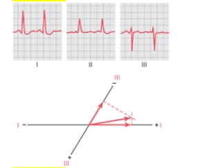 Following Questions : A 60-year-old woman had the following EKG recorded at a local emergency room following an automobile accident. Her weight was 70 kg and her aortic blood pressure was 140/80 mmHg.   -What is the heart rate using lead I for the calculation? A) 75 B) 88 C) 100 D) 112 E) 148