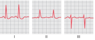 Following Questions :A 70-year-old man had the following EKG recorded at his doctor's office. His weight was 80 kg and his blood pressure was 160/90 mmHg. He complained that he gets tired easily.   -What type of heart murmur does this patient have? A) tricuspid valve regurgitation B) completeri bundle branch block C) pulmonary valve stenosis D) pulmonary valve regurgitation E) aortic regurgitation