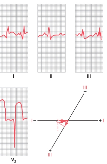 A seventy-year-old woman came into the local emergency room complaining of chest pain and shortness of breath. Blood samples were taken for cardiac enzyme measurements, and an EKG was quickly taken. Based on the EKG tracing shown below, what is the likely diagnosis?   A) Left bundle branch block B) Acute anterior wall infarction in the left ventricle C) Acute anterior wall infarction in the right ventricle D) Acute posterior infarction in the left ventricle E) Acute posterior infarction in the right ventricle