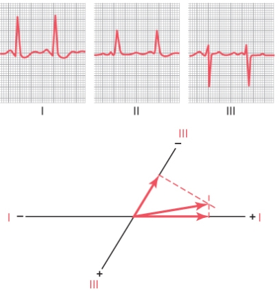 Following Questions :A 65-year-old man went for an annual checkup and had the following EKG recorded at his physician's office.   -What is the most likely diagnosis? A) Right ventricular hypertrophy B) Left bundle branch block C) Pulmonary valve insufficiency D) Right bundle branch block E) Systemic hypertension