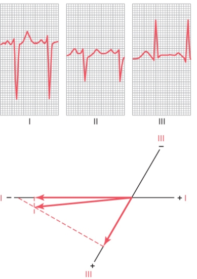  Following Questions :A 6-year-old boy had the following EKG recorded at his physician's office. He had little energy, and during light exercise his respiratory would increase rapidly.   -What is his mean electrical axis calculated from standard leads I, II, and III shown in his EKG? A.  - 100 ^ { \circ }  B.  - 20 ^ { \circ }  C.  0 ^ { \circ }  D.  + 90 ^ { \circ }  E.  + 170 ^ { \circ }
