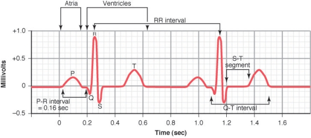 Use the following information to answer Following Questions . A 70-year-old woman had an electrocardiogram performed at her annual checkup, and the following lead II recording was made.   -According to Einthoven's Law, if the QRS voltage in lead III is 0.4 mV, what is the QRS voltage in lead I? A) 0.05 millivolts B) 0.50 millivolts C) 1.05 millivolts D) 1.25 millivolts E) 2.05 millivolts