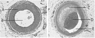   Use the figure above to answer the following questions. -The anatomical structure identified with the letter  C  in the figure above is A)  the arterial wall. B)  the lumen. C)  atherosclerotic plaque. D)  the capillary wall. E)  none of these.