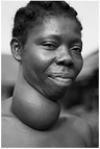   -The woman in the above photograph has been afflicted by A)  low iodine in the diet. B)  hypothyroidism. C)  vitamin D deficiency. D)  testosterone excess. E)  progesterone deficiency.