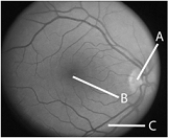   -The letter  B  in the above figure represents A)  cortex. B)  cornea. C)  fovea. D)  blood vessels. E)  optic nerve.