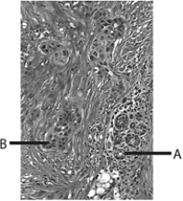 <strong> Which letter in the above figure represents breast cancer?</strong> A) A B) B C) both A and B D) neither A or B E) this is prostate tissue