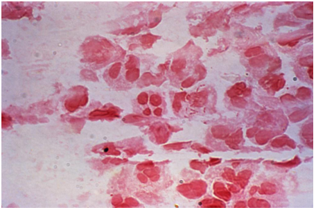 Review the Gram stained urine image provided. Which organism listed best correlates with this Gram stain reaction?   A)  Beta-hemolytic, catalase negative, and PYR positive B)  Beta-hemolytic, catalase and coagulase positive C)  Gamma-hemolytic, swarmer, oxidase, and spot indole negative D)  Alpha-hemolytic, catalase negative, and bile soluble
