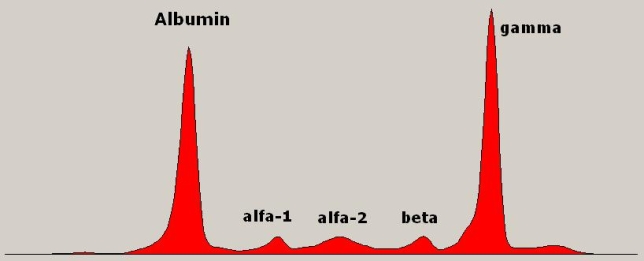 Using the image provided, which of following diseases is represented in the results of this zone electrophoresis test?   Source: Steven Fruitsmaak A)  Syphilis B)  Rheumatoid arthritis C)  HIV D)  Multiple myeloma