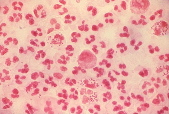 A 17-year-old female presents with burning on urination. The physician sends the laboratory a voided urine sample and swab of the urethra of this patient. The urine and swab are plated and a direct Gram stain of the urethral swab is performed. The image provided demonstrates the results of the direct Gram stain of the urethra.   Source: CDC and Joe Miller This Gram stain considered diagnostic for ___________. A)  a urinary tract infection and the urine culture is not needed. B)  trichomoniasis and neither the urine nor urethral culture is needed. C)  gonorrhea and the urethral culture is not needed. D)  unable to diagnose from the Gram stain.